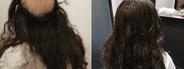 Hair Replacement SG